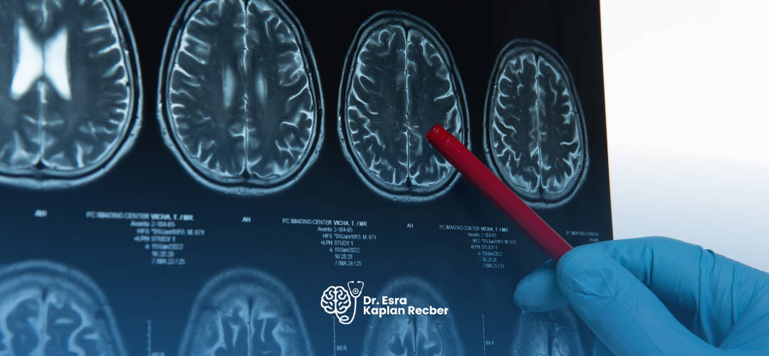 Serebrovasküler Hastalıklar (Beyin Damar Hastalıkları) Nedir?